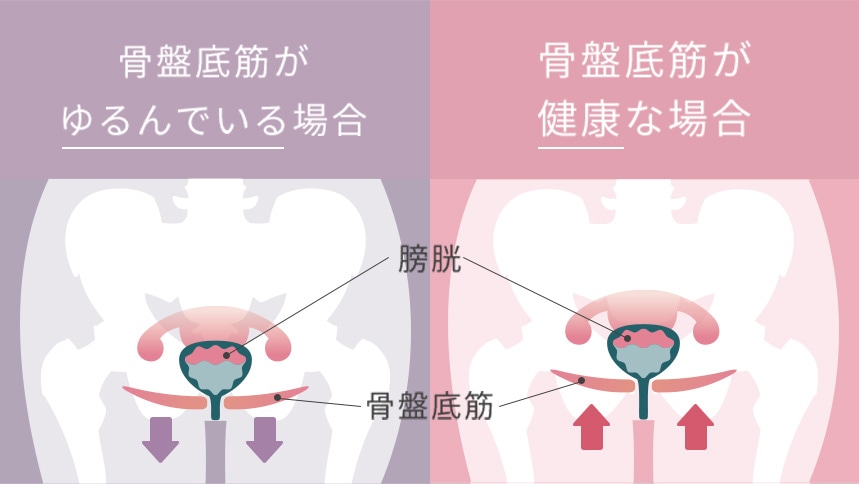 骨盤底筋がゆるんでいる場合 骨盤底筋が健康な場合